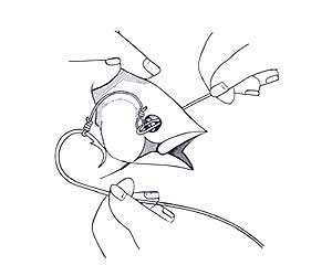 Bridle Rigging Step 4